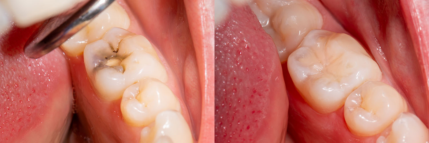 Flossophy | Dental Bridges, Dental Fillings and Full Mouth Reconstruction